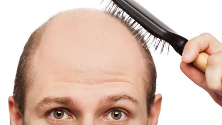 Major causes of hair loss